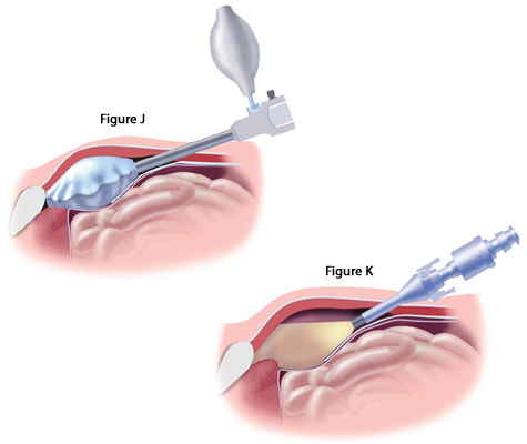 Laparoscopic Inguinal Hernia Repair